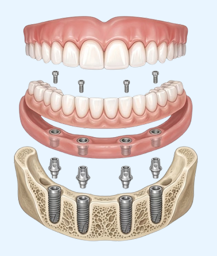 Dentures vs Dental Implants