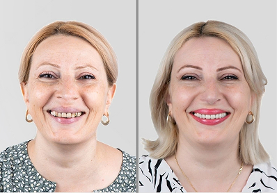 Smile transformation two