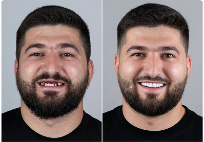 Smile transformation three