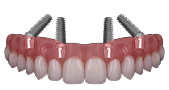All-on-4 Dental Implants