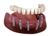All-on-6 Dental Implants